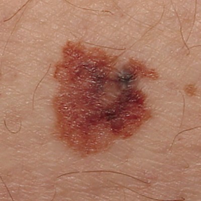 Superficial spreading melanoma